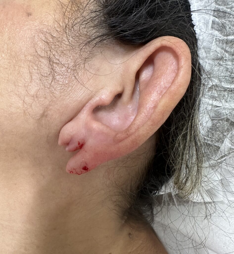 Cirurgia Dermatológica - Lobulo de orelha rasgado