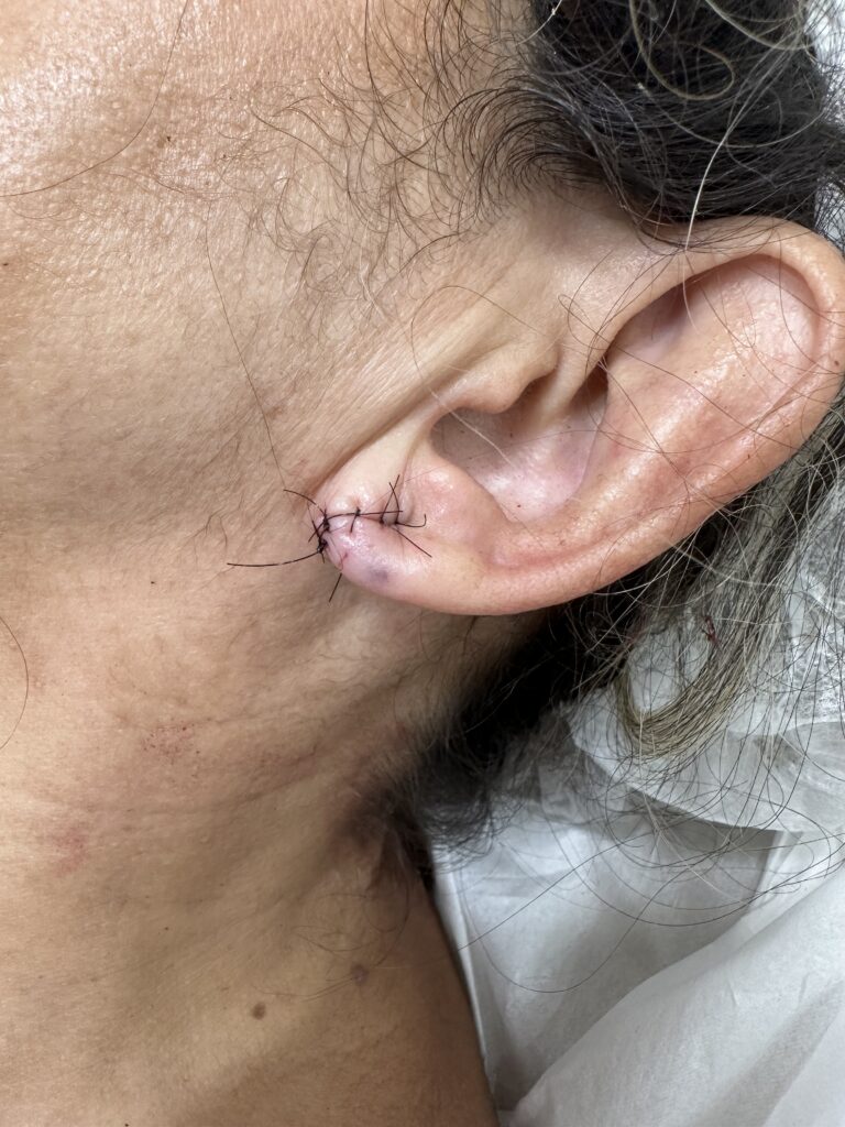 Cirurgia DermatológicaReconstituiçao de lobulo da orelha