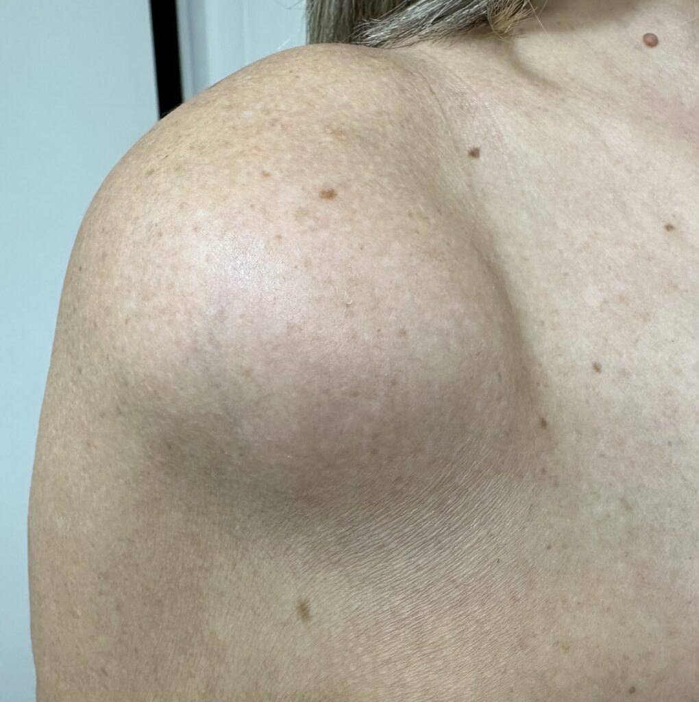 cirurgia dermatológicalipoma volumoso no ombro