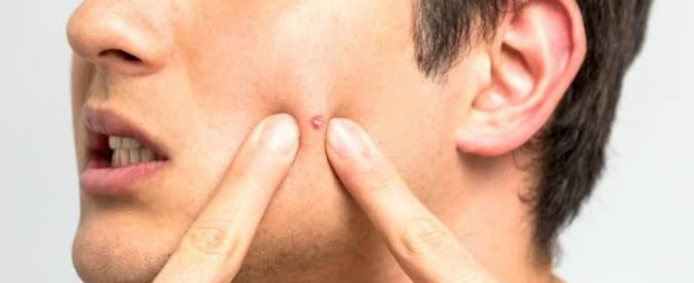 Homem espremendo uma espinha. Piora das cicatrizes de acne