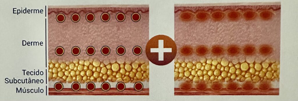 Camadas atingidas pelo Ultrassom Microfocado para promover o Rejuvenescimento.