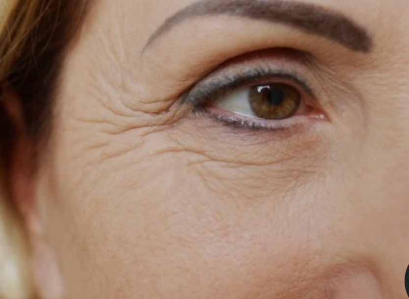 Rejuvenescimento -tratamento de rugas emtorno dos olhos