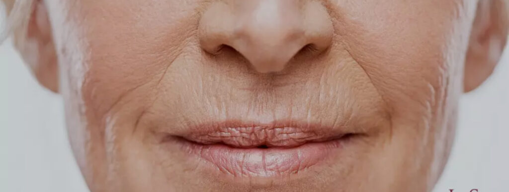 rejuvenescimento - rugas em torno da boca