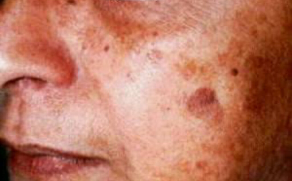 rejuvenescimento - fotoenvelhecimento