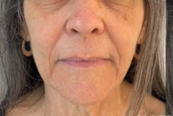 rejuvenescimento - bigode chinês e rugas de marionete