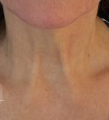 rejuvenescimento - flacidez de pescoço