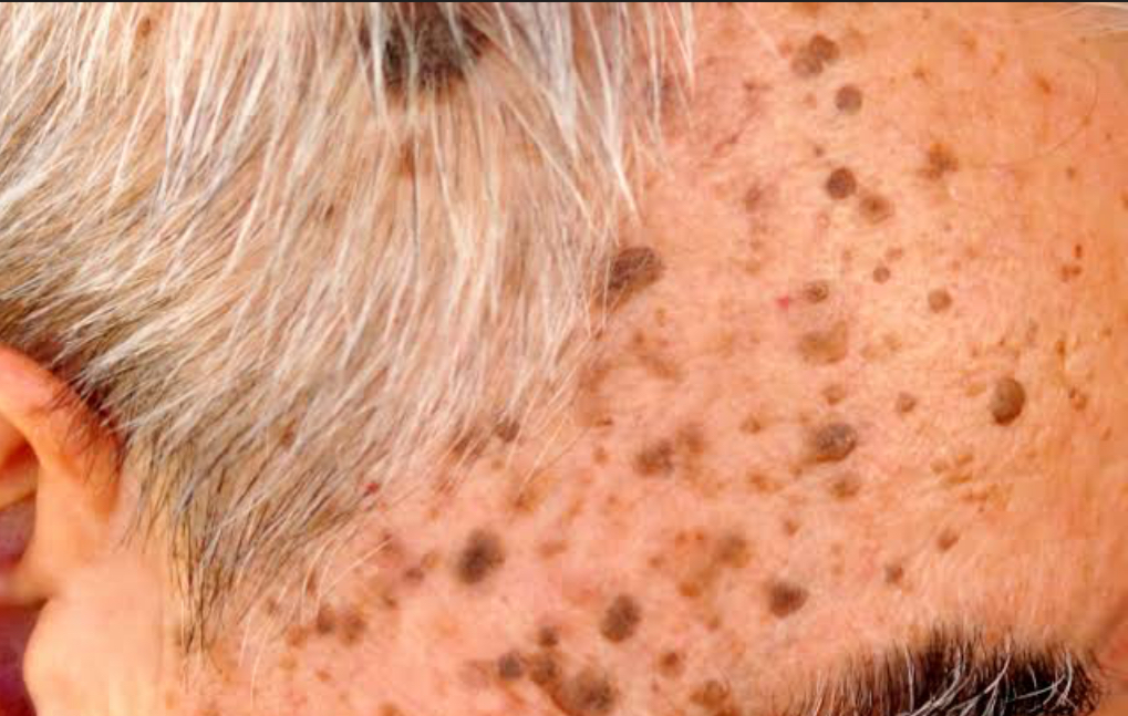 cirurgia dermatológica ceratose seborreica