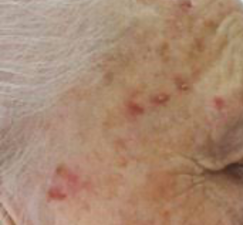 cirurgia dermatologica ceratose actínica