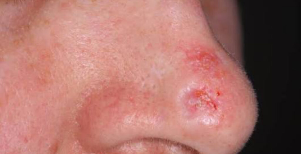 Carcinoma basocelular. Tratado com cirurgia dermatológica.
