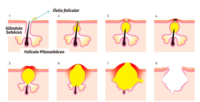 Folículo pilossebaceo mostrando a sequência de eventos da acne. A obstrução por sebo, a inflamação com formação de pústula, abscesso e a drenagem espontânea, levando à formação de cicatriz.
