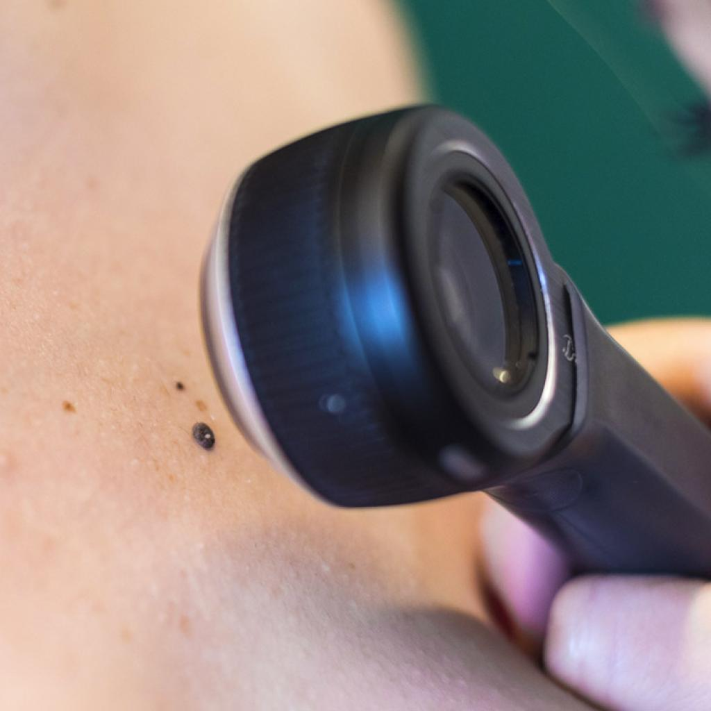 dermatologista fazendo dermatoscopia num sinal
