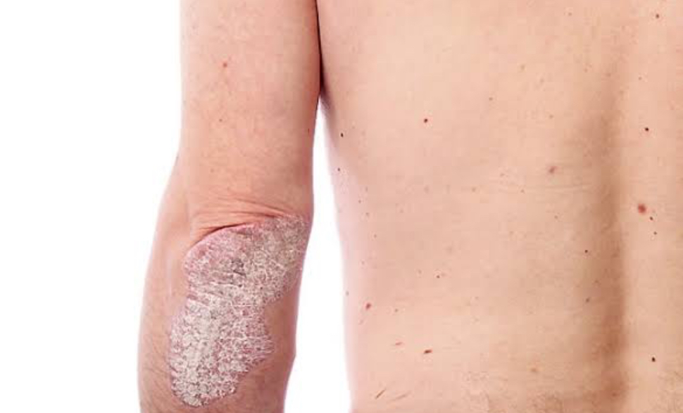 Psoríase no cotoveloExacerbação no inverno