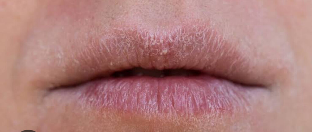 Labios ressecados no Inverno