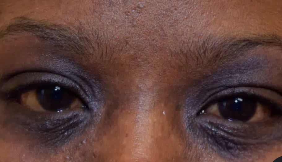 Dermatite atópica em torno dos olhos. O inverno é a época crítica