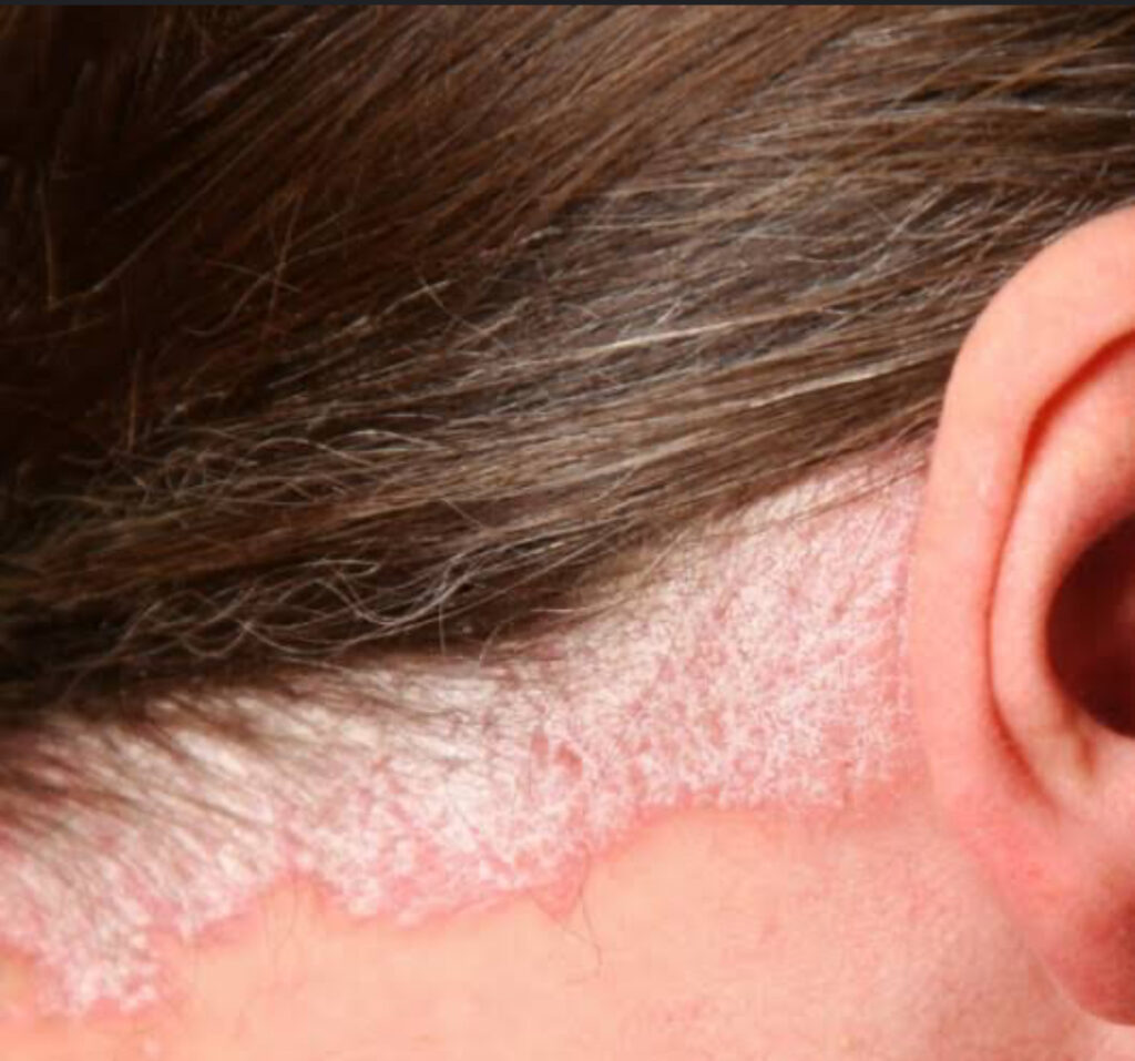 psoríase no couro cabeludoSempre mais intensa no Inverno