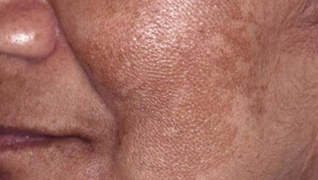 melasma - manchas acastanhadas rendilhadas na faceO inverno é a época ideal para controlar