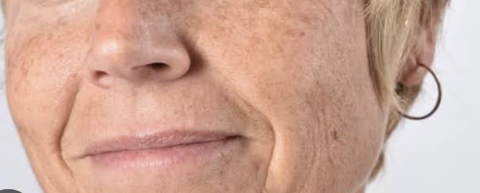 pele fotoenvelhecida com lentigosO Inverno é o período para rejuvenescer