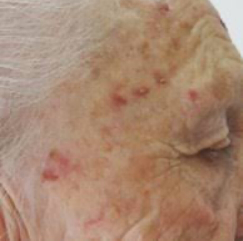 pele da face com varias ceratoses actínicas. Peelings e tratamentos devem ser feitos no Inverno