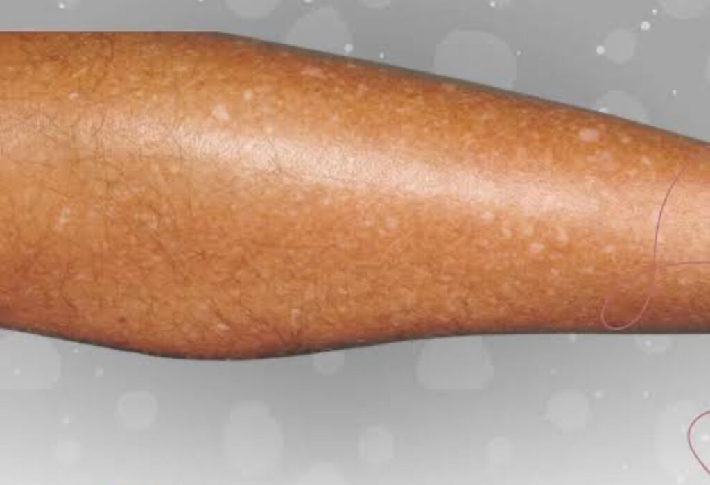 leucodermia GutataPode ser tratada no inverno