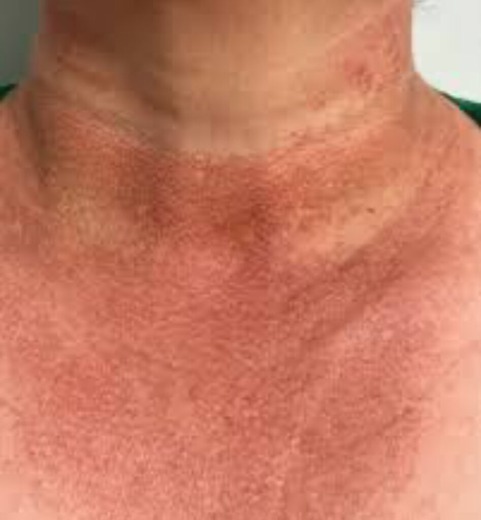 poiquilodermia. O Inverno é a epoca para tratar