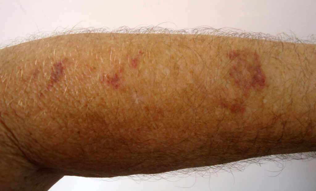 púrpura senilTratamento no inverno