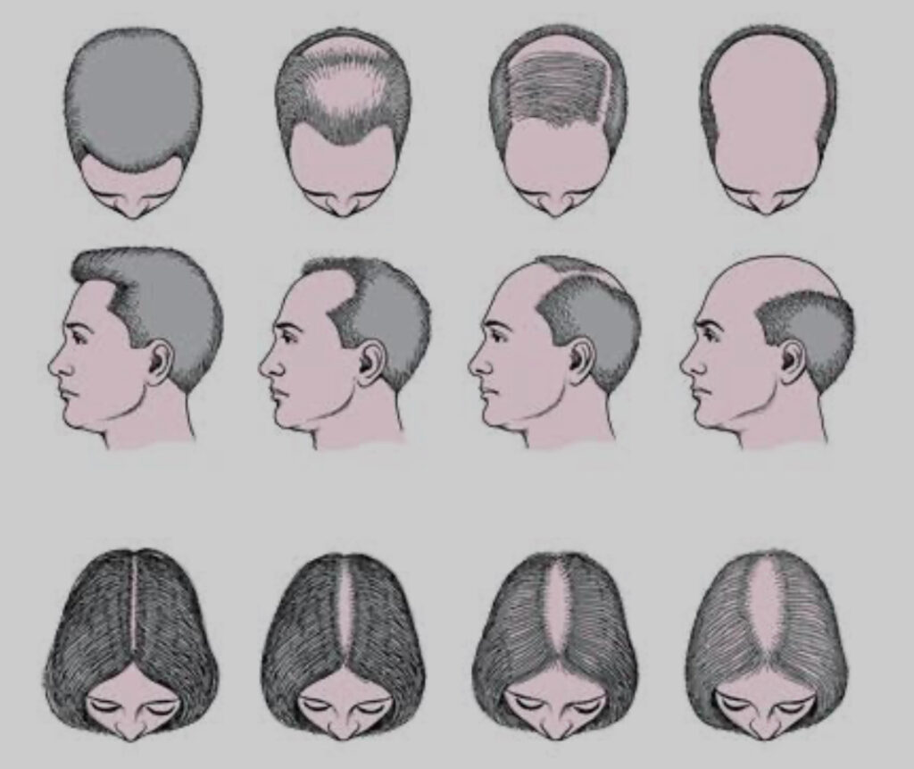 padrões de alopécia androgenetica no homem e na mulher