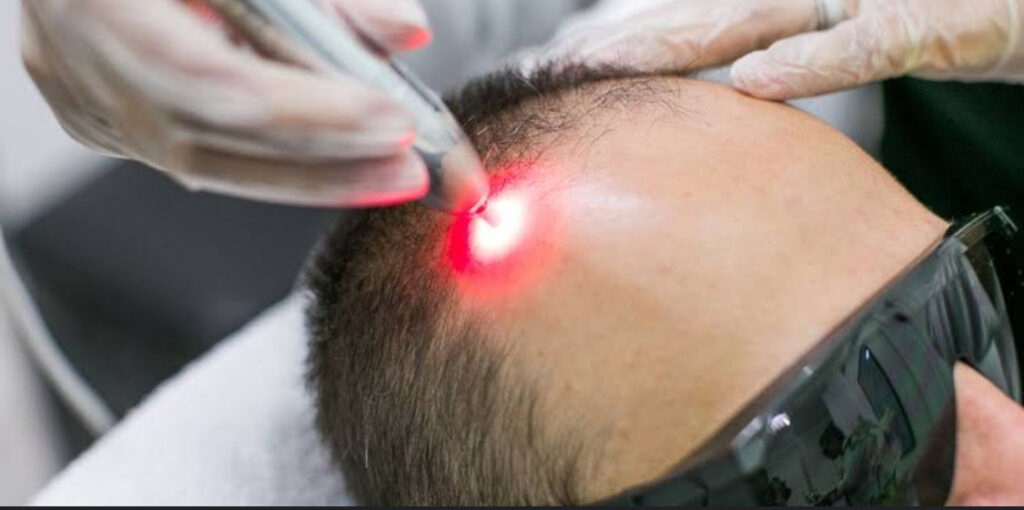 laser de baixa potencia - bioestimulador, para tratamento de alopécias