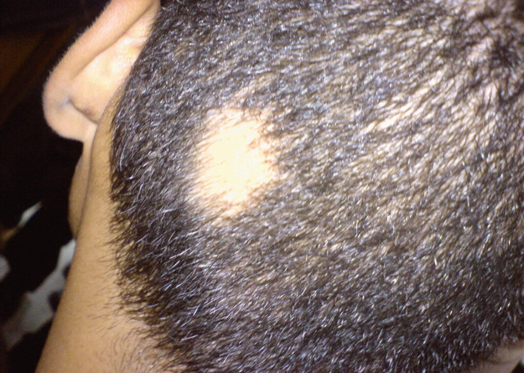 alopecia areata
