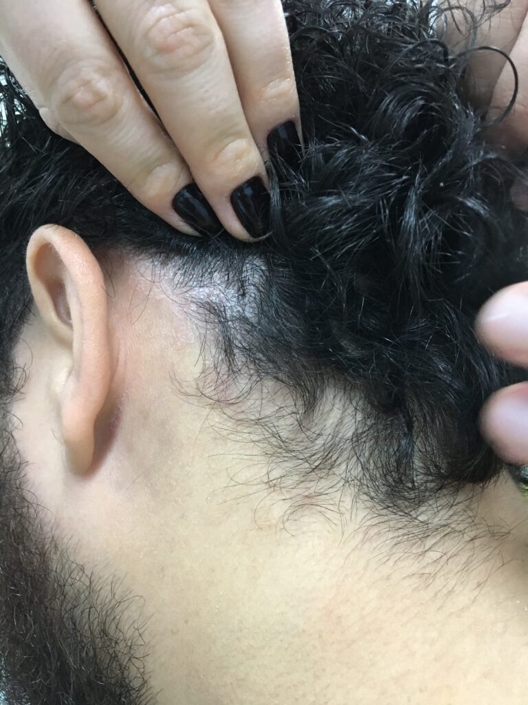 Descamação no couro cabeludo - dermatite seborreica. Mais acentuada no inverno