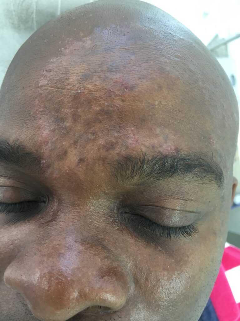 dermatite seborreica na região dos supercílios. Piora no inverno