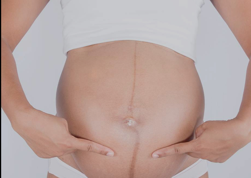 Gestação. Progesterona aumenta o melasma