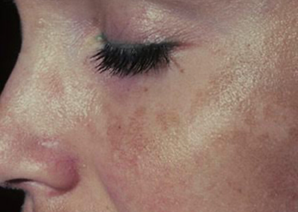 Melasma malar rendilhado