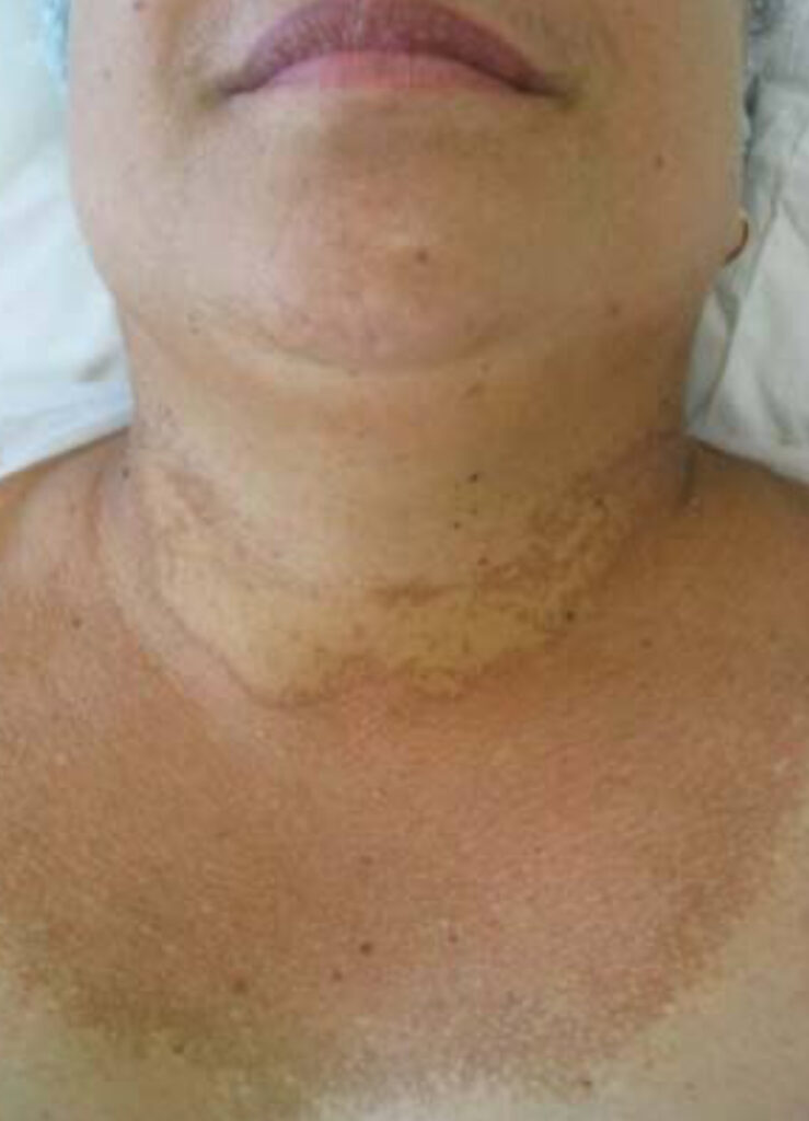Poiquilodermia. Diferencial com melasma