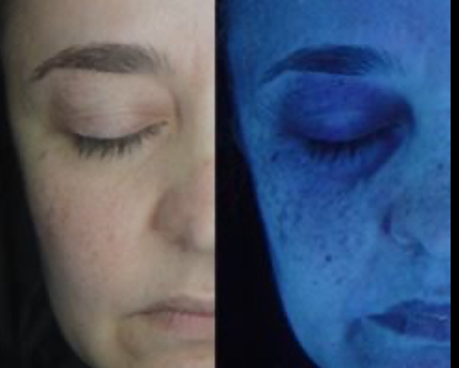 Luz de Wood - evidencia o melasma