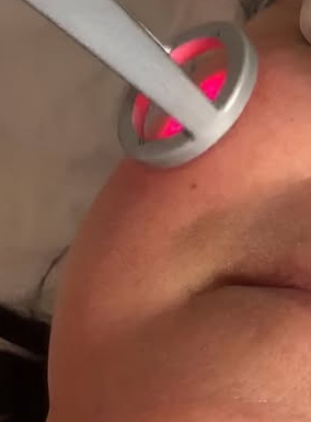 laser Lavieen - tratamento de melasma