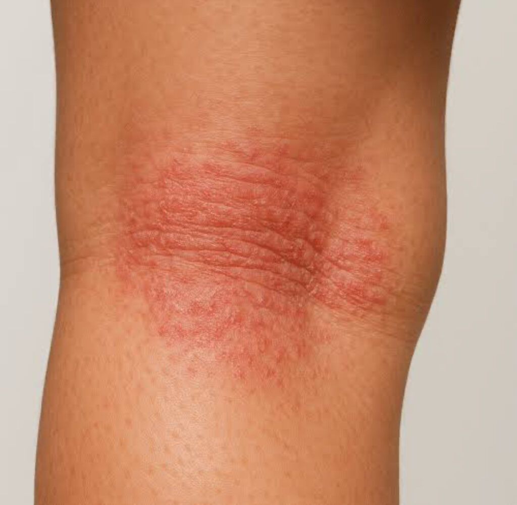 Dermatite atopica Liquenificação 