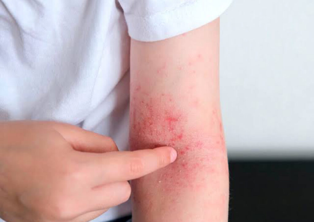 dermatite atopica no escolar