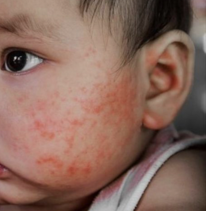 Dermatite atopica no lactente