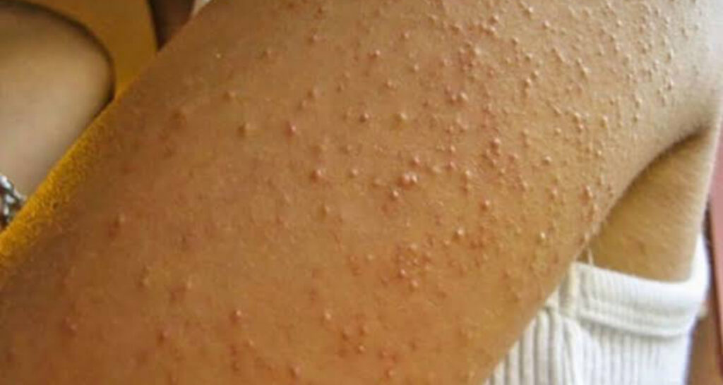 dermatite atopica Ceratose Pilar