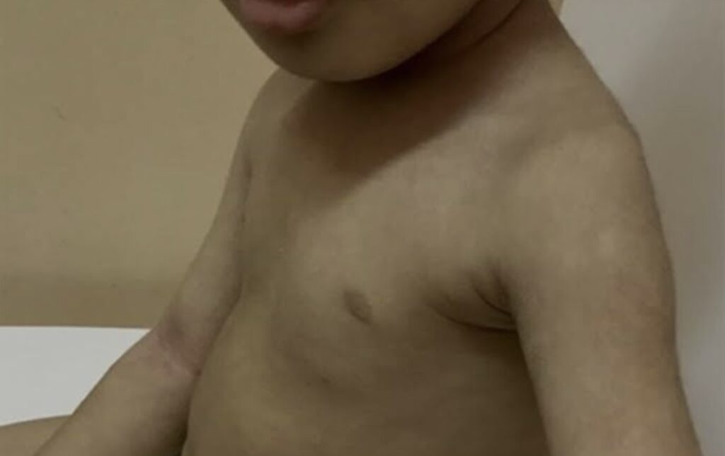 dermatite atópica pitiriase alba