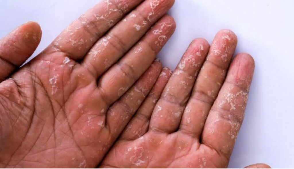 dermatite atopica no adulto