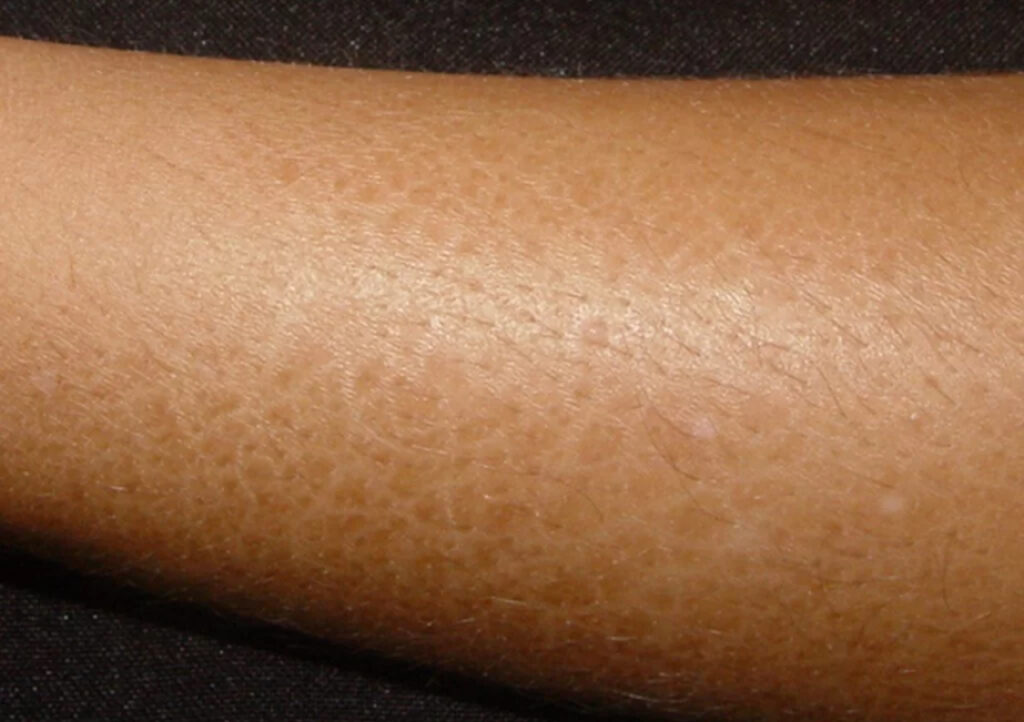 Dermatite atopica Xerodermia