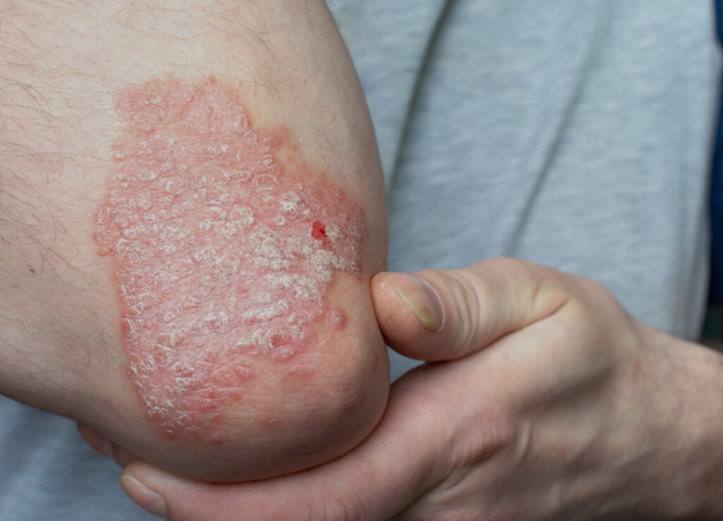 Psoríase em placas