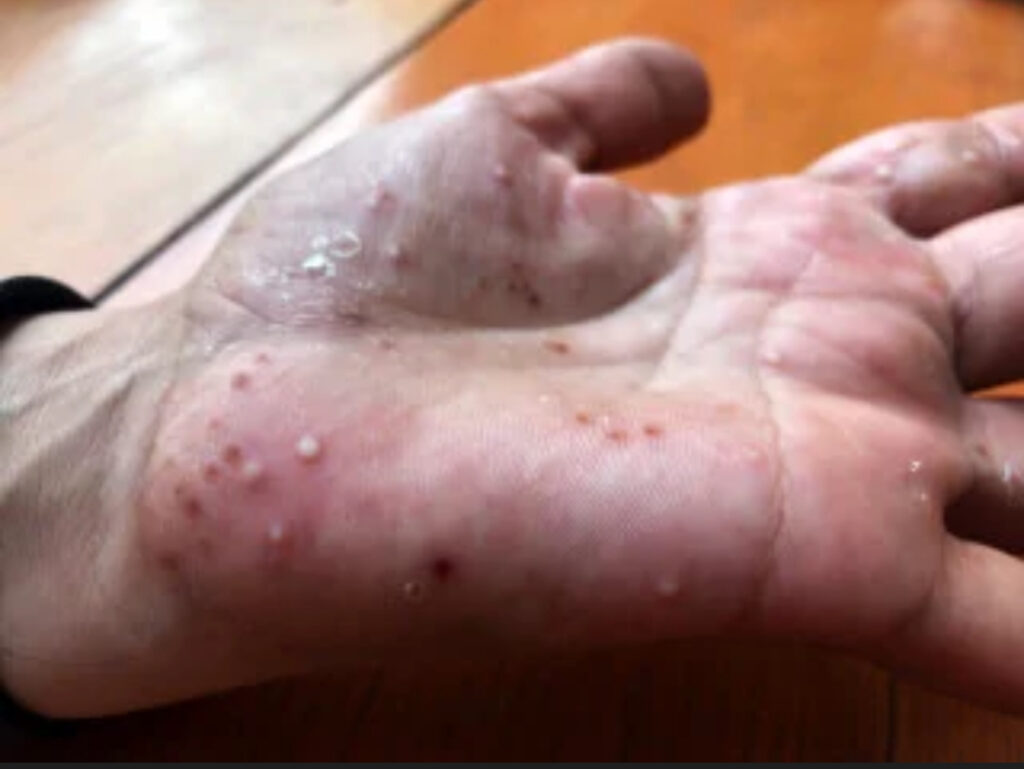 Psoríase Pustulosa das mãos