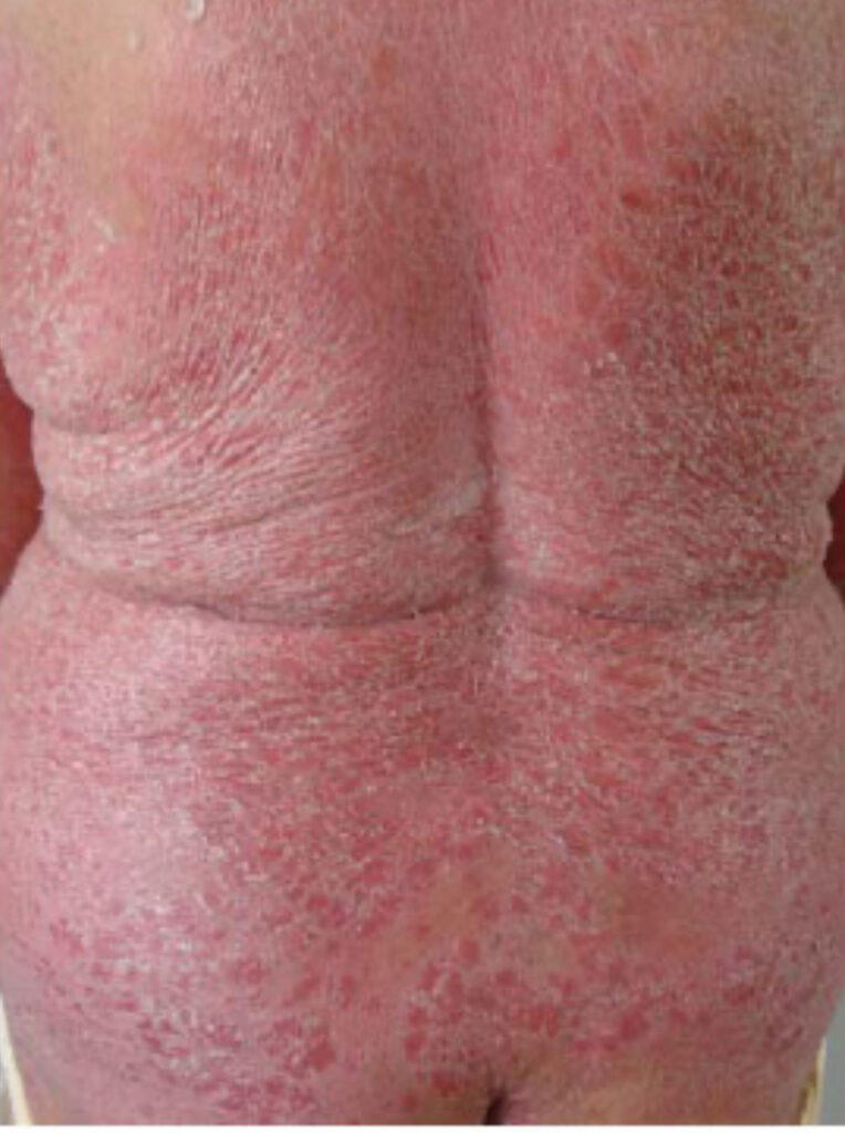 Psoríase Eritrodermica