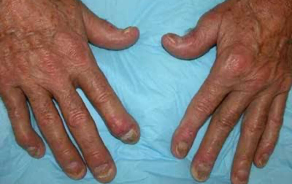 Artrite da Psoríase