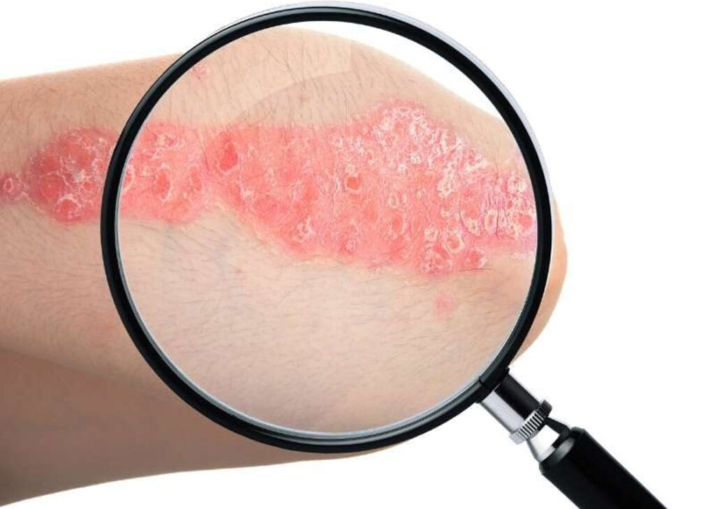 Exame da psoríase
