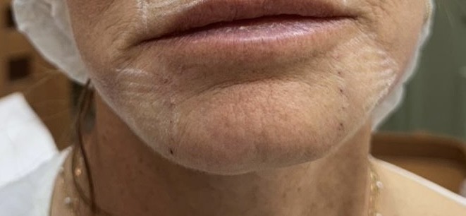 fios de bioesímulo infralabial