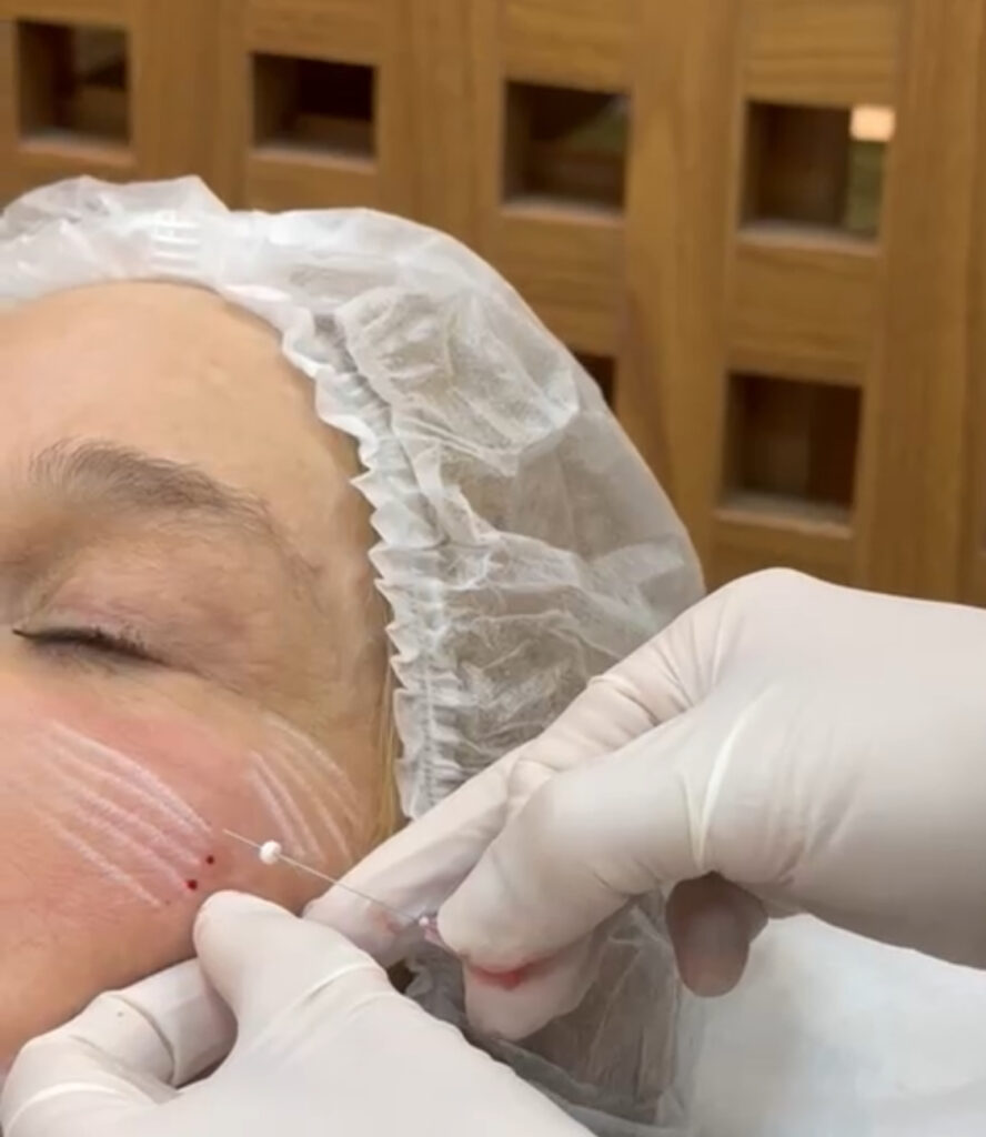 Fios de Bioestímulo para correçao de depressão na goteira lacrimal e pés de galinha