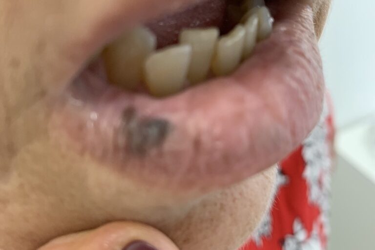Câncer de pele. Melanoma